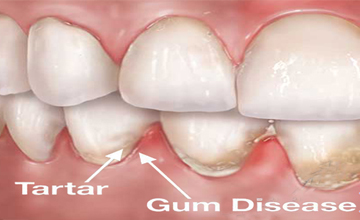 Bryan Dental Periodontal (Gum) Disease service
