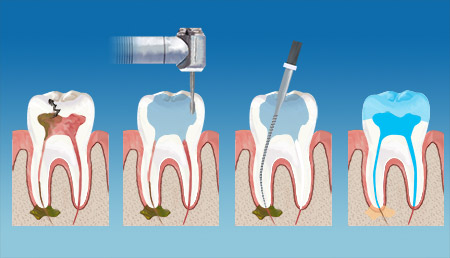 Bryan Dental Endodontics Therapy service